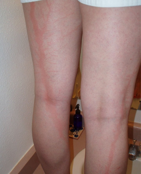 После разряда — что происходит с человеком, в которого ударила молния